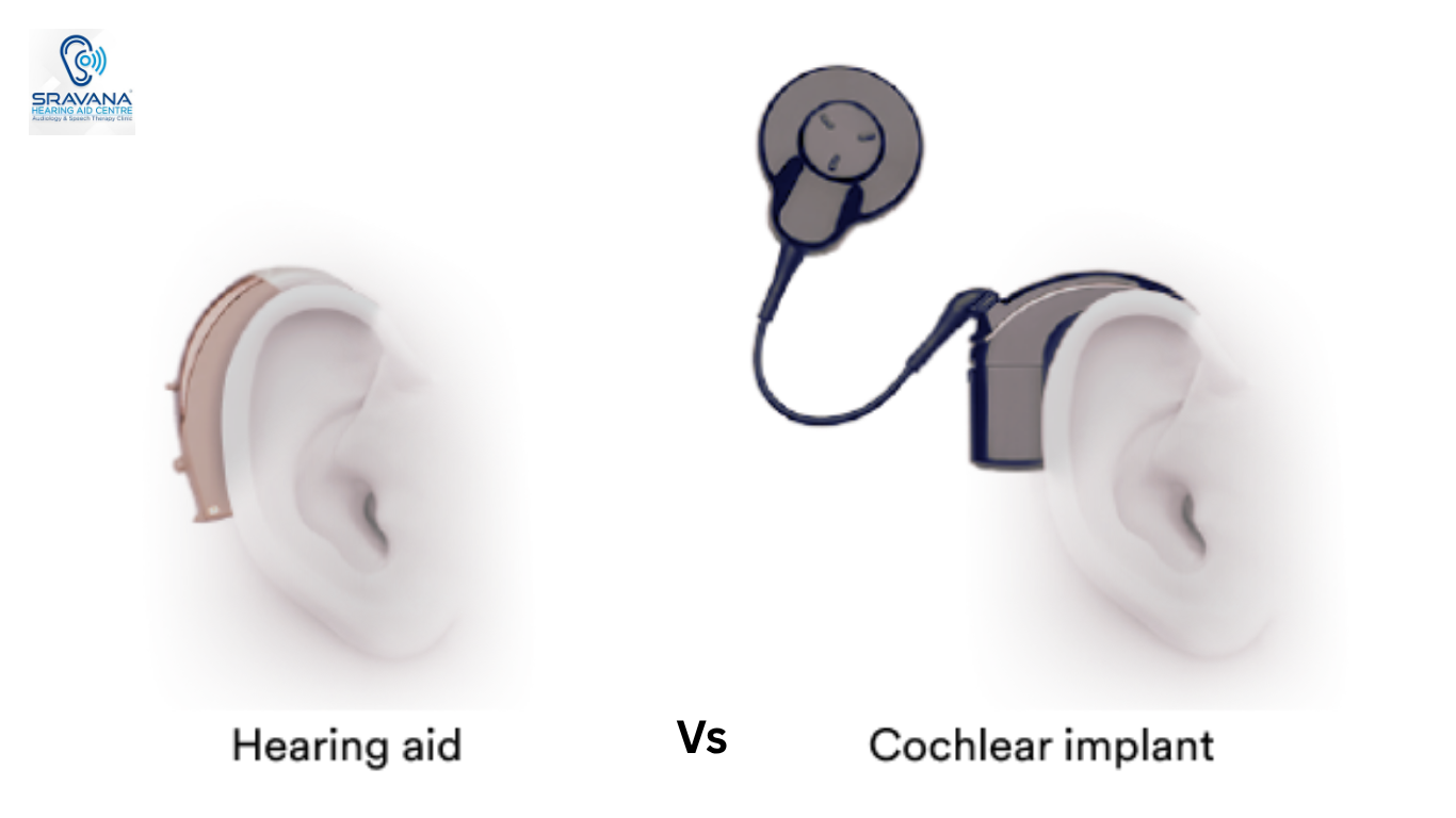 Hearing Aid vs. Cochlear Implant